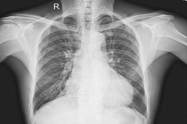 An x-ray of human lungs.